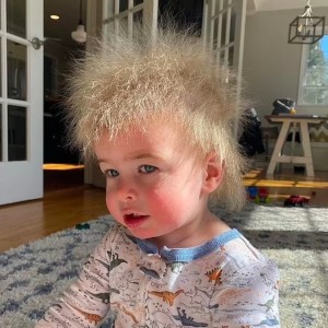 عکس عجیب ترین سندروم ها