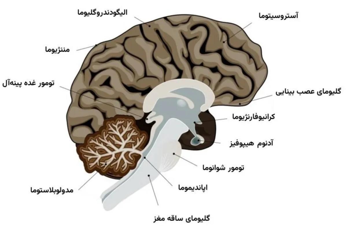 عکس علایم تومور مغزی و چند نمونه