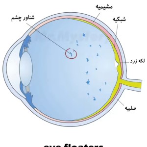 عکس لکه های شناور در چشم چیست؟