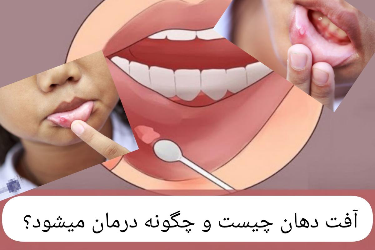 عکس آفت دهان چیست و چگونه درمان میشود؟
