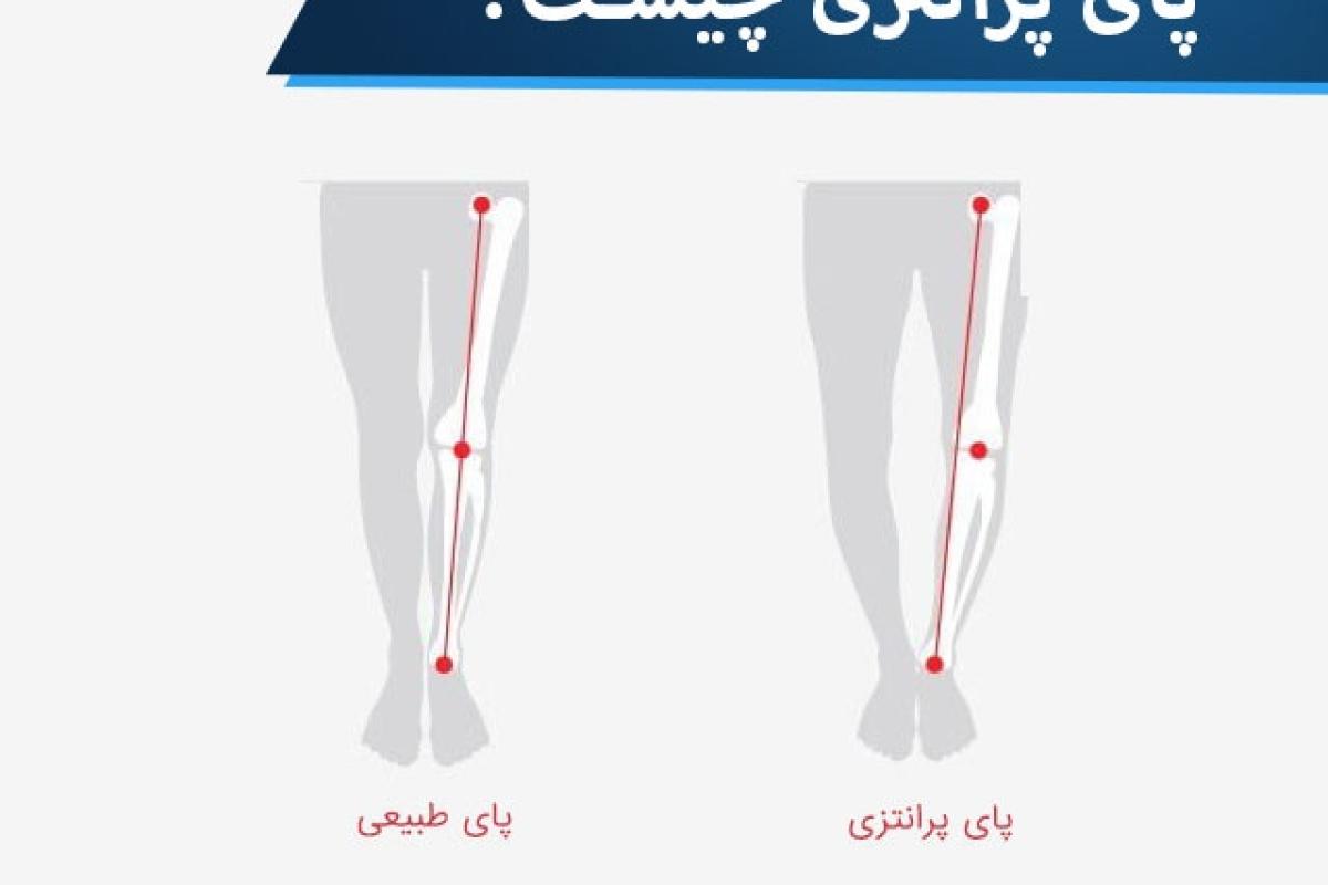 عکس ابتلا به پای پرانتزی ؟؟..