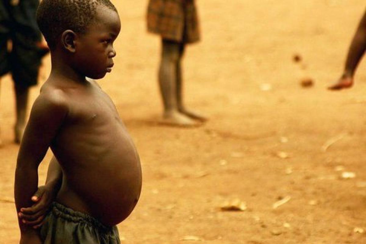 عکس کواشیورکور؛ بیماری کودکان جهان سومی‌