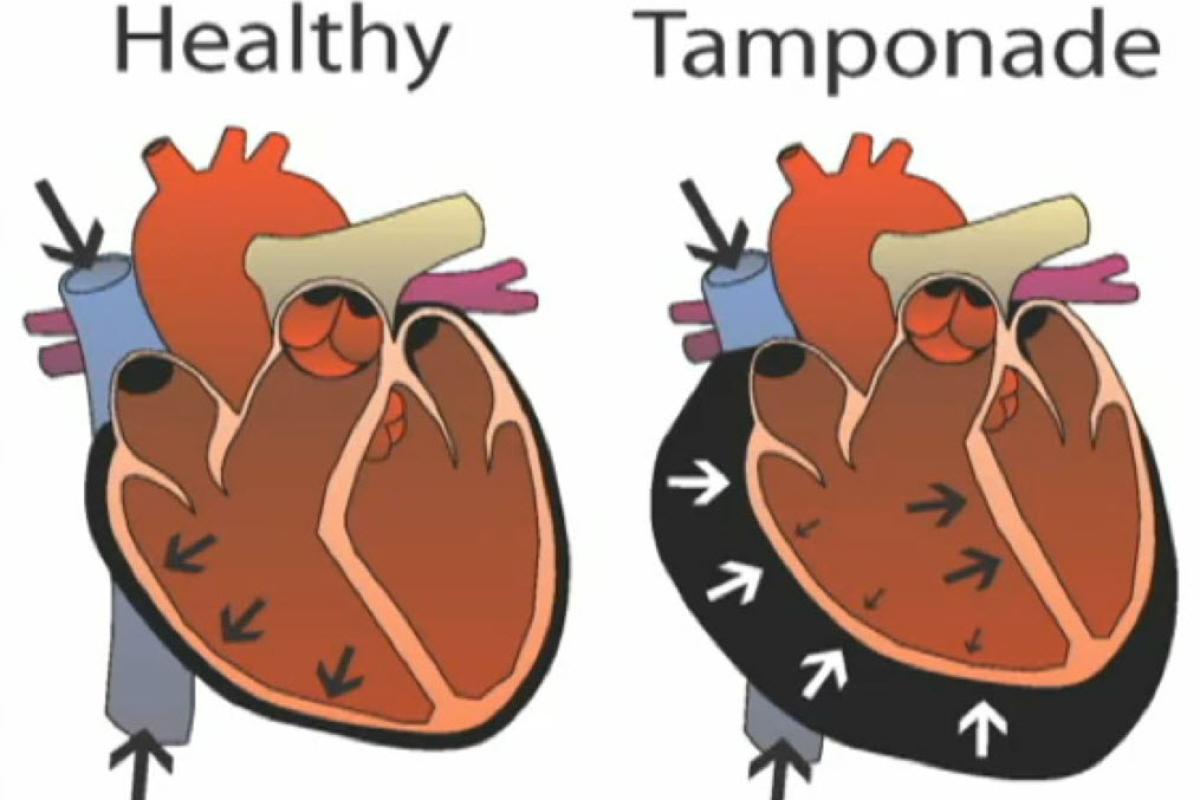 عکس تامپوناد قلبی چیست ؟
