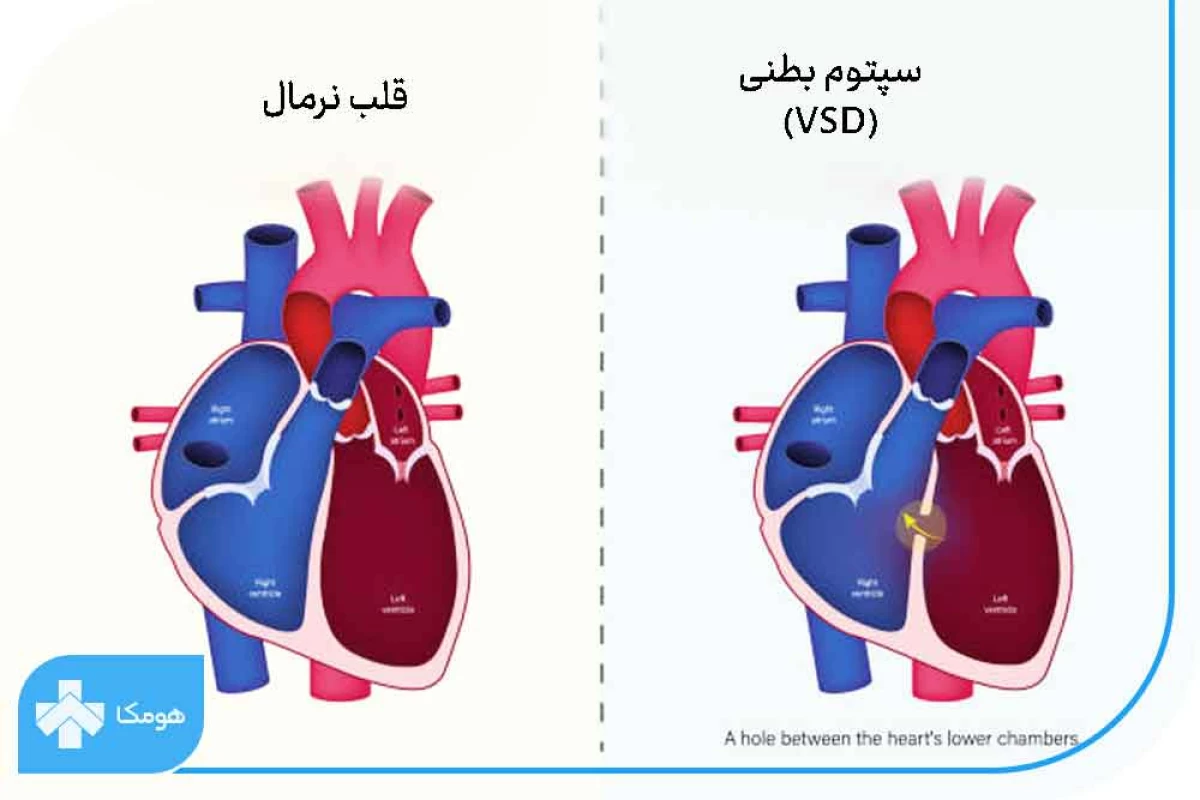 عکس VSDچیست؟
