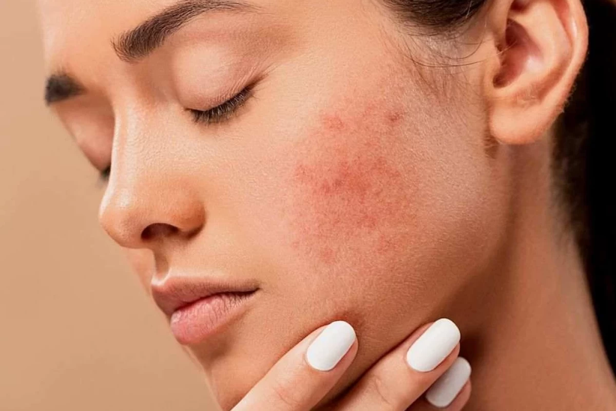 عکس جوش های صورت