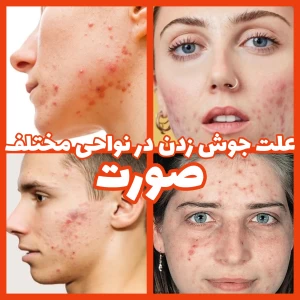 دلیل جوش زدن در نواحی مختلف صورت