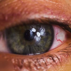 عکس همولاکریا چیست؟و دلیل آن چیست؟