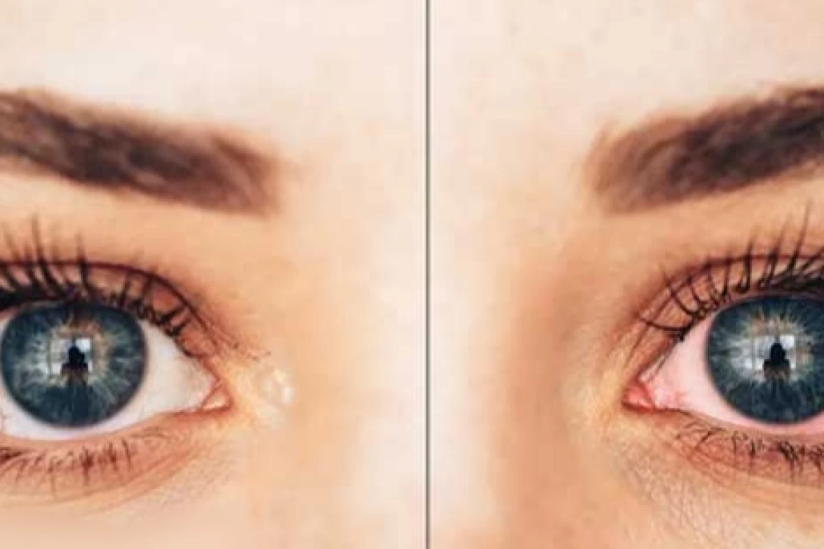 عکس همولاکریا چیست؟و دلیل آن چیست؟