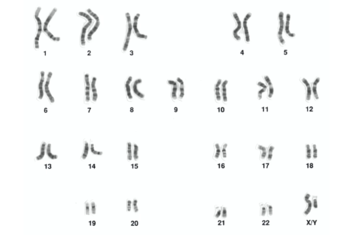 عکس آشنایی با مهم‌ترین اختلالات کروموزومی (پارت اول)