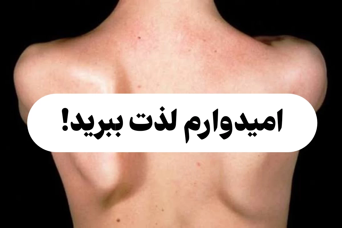 عکس سندروم کتف بالدار