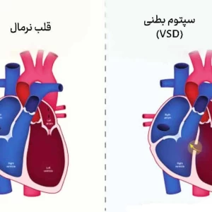 عکس بیماری VSD