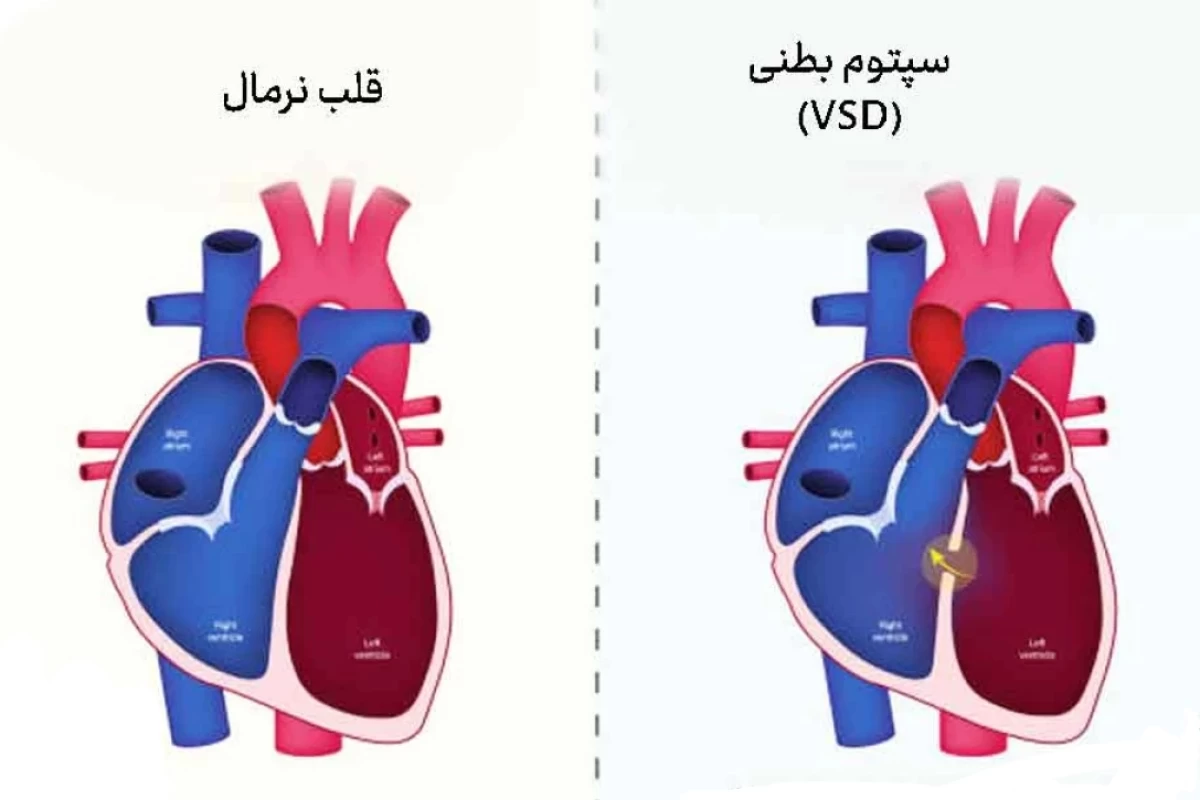 عکس بیماری VSD